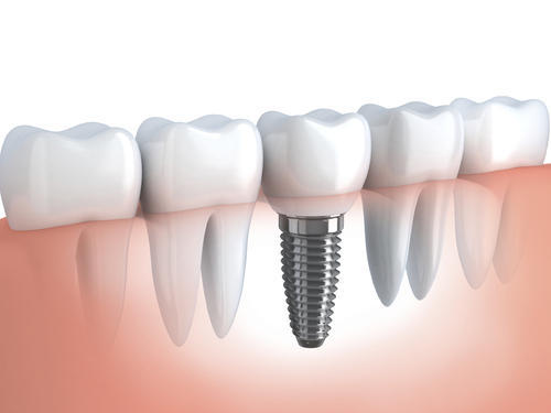 Dental Implant Graphical view