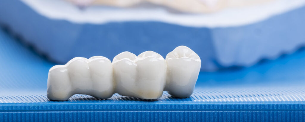 Common Challenges of Crowns and Bridges: Insights from Pune’s Leading Orthodontist