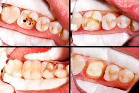 Root Canal Specialist Near Me
