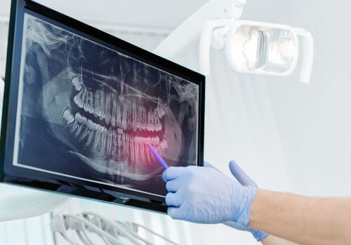 3D Dental X-Ray