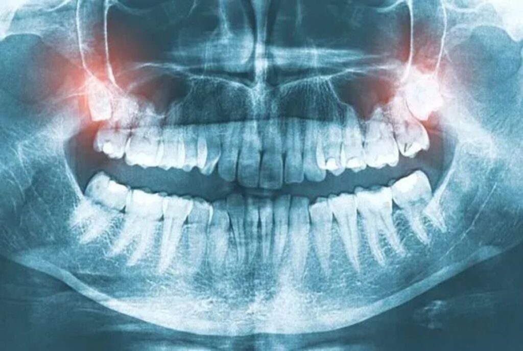 3D Dental X-Ray