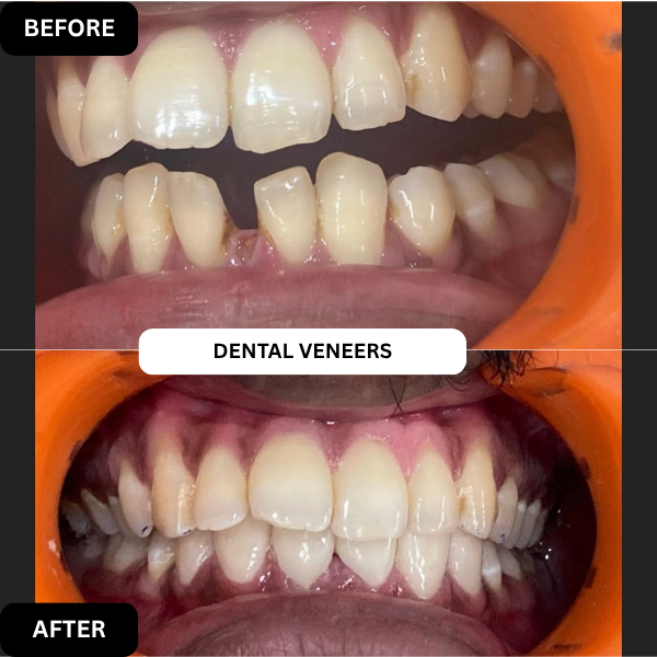 Dental Veneers
