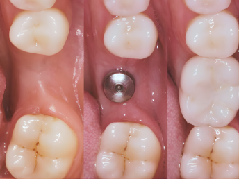 Dental Implants