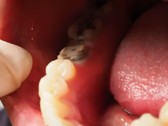 Root Canal Treatment