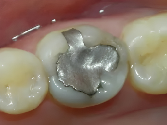 Dental Filling
