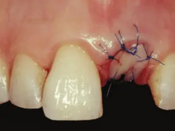 Periodontal Treatment (Gum Care)