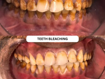 Teeth Cleaning