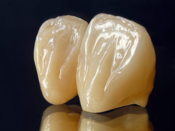 Dental Crown and Bridges